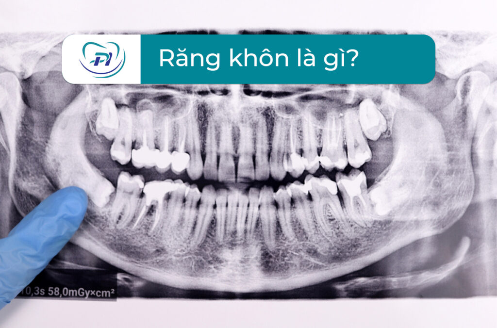 Răng khôn là gì? Nhổ răng khôn ở Hạ Long