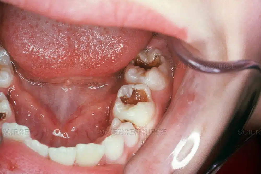 Điều trị viêm tuỷ răng