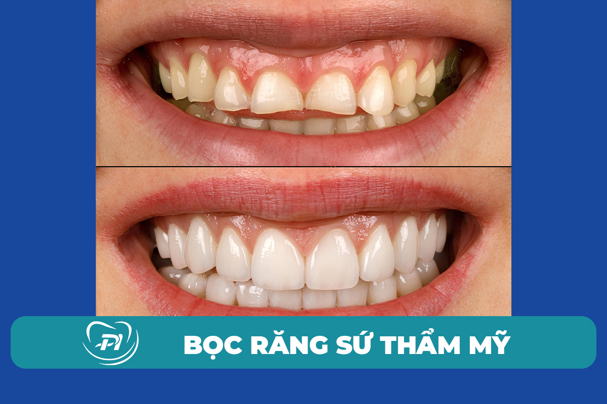 bọc răng sứ giá rẻ tại Hạ Long
