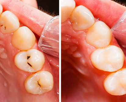 Hàn răng tại Hạ Long