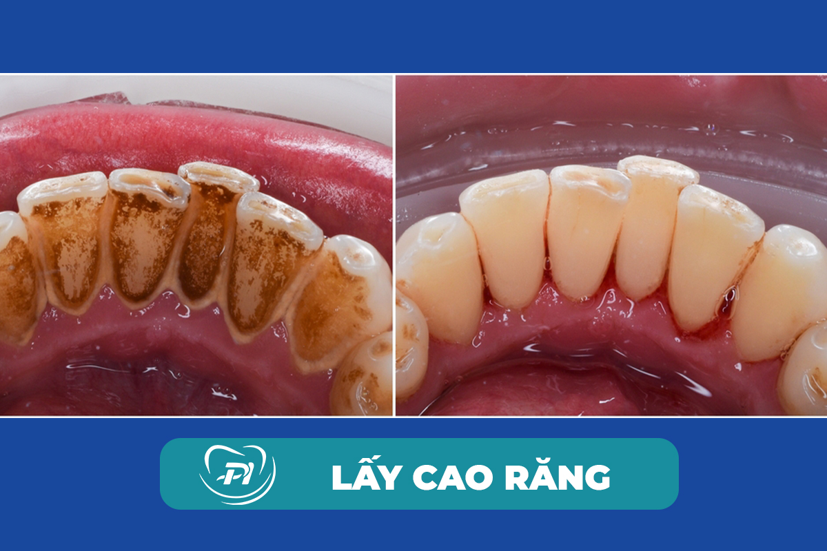 Dịch vụ lấy cao răng giá rẻ tại Hạ Long