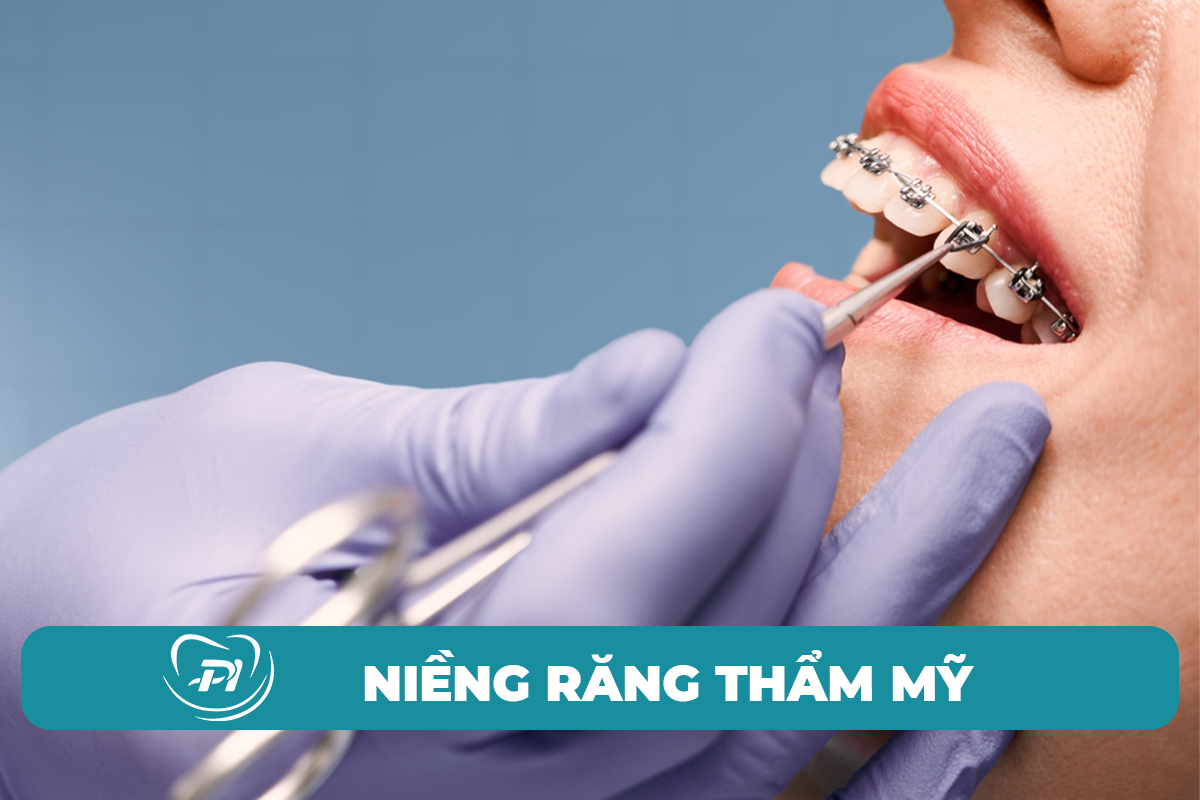 niềng răng tại hạ long