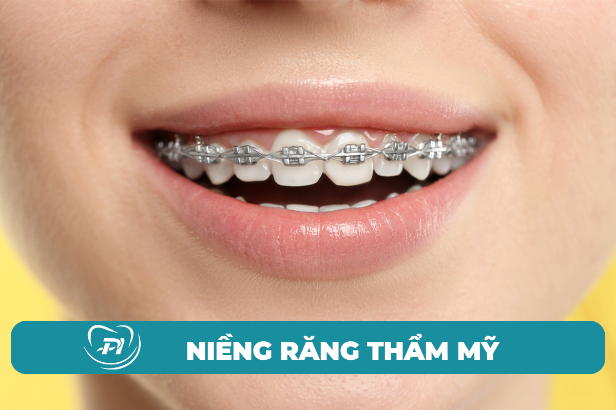 Dịch vụ niềng răng thẩm mỹ tại Hạ Long