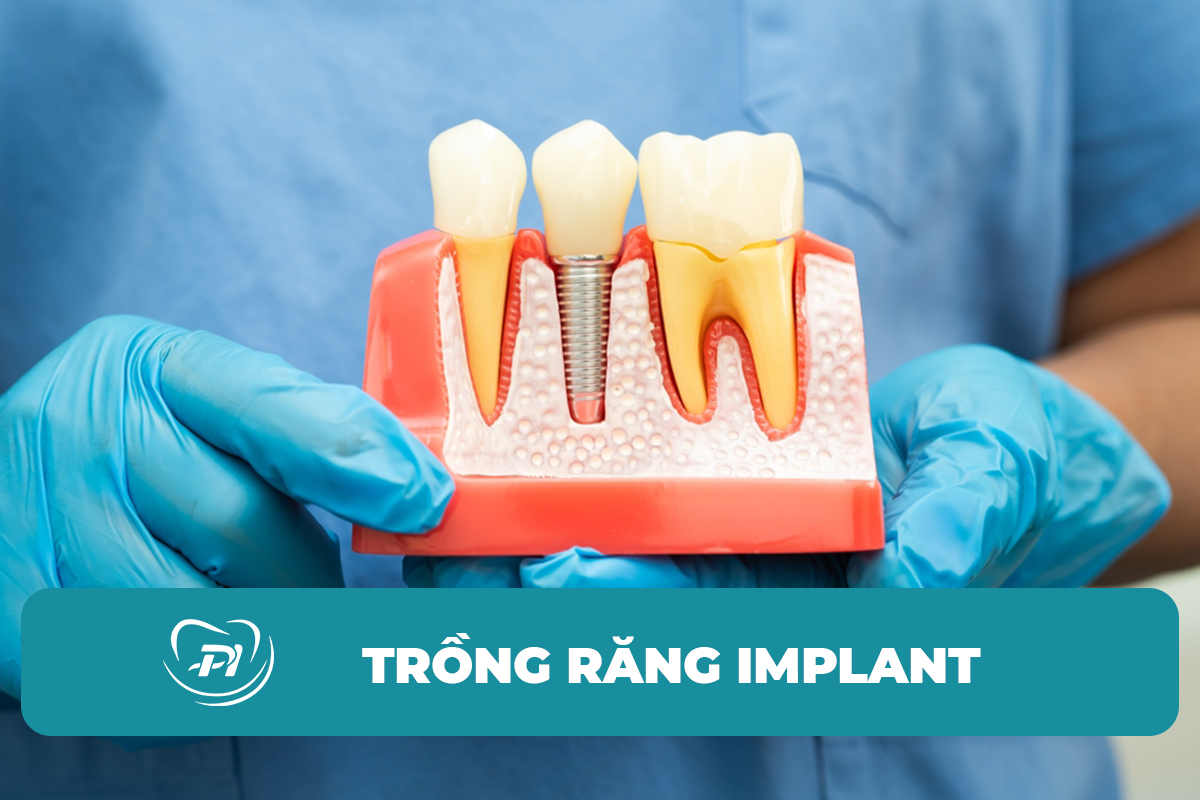 Dịch vụ trồng răng Implant Hạ Long nha khoa quốc tế american
