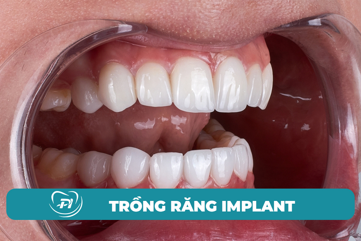 Kết quả trồng răng Implant