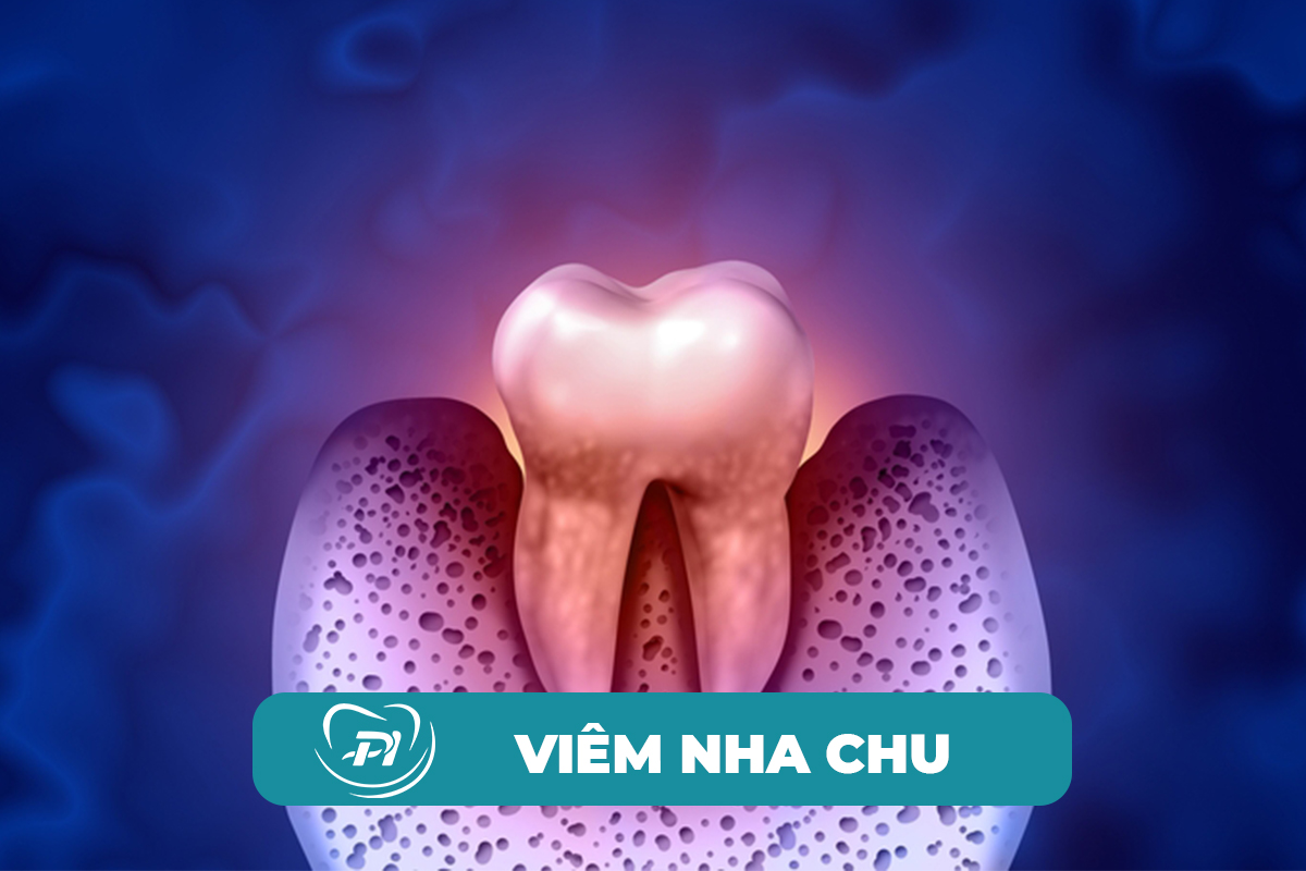 điều trị viêm nha chu tại hạ long