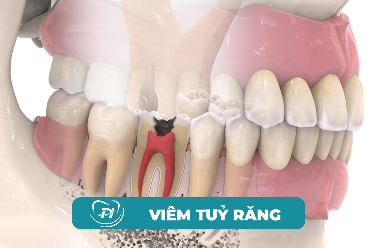 Điều trị viêm tuỷ răng tại nha khoa hạ long